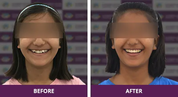 Young teen girl smiling after expert braces treatment at Complete Dental Care in New Delhi.