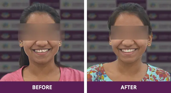 Young girl’s broken teeth professionally restored with fixed crowns at Complete Dental Care, New Delhi.