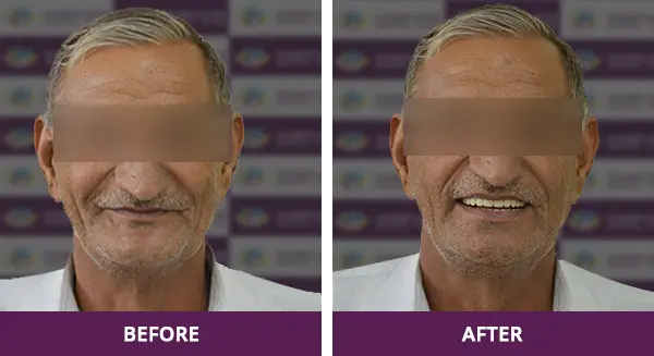 Elderly patient with expertly fitted complete dentures restoring function and aesthetics at Complete Dental Care, New Delhi.