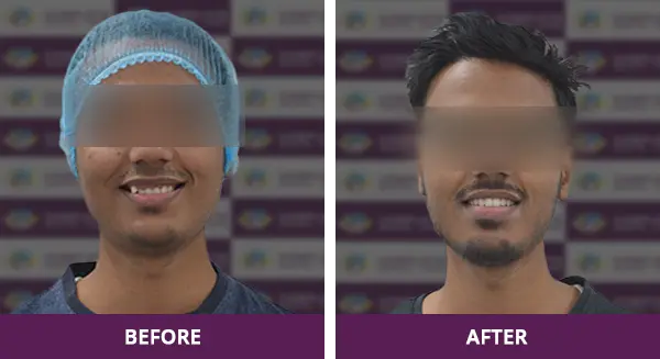 Young adolescent boy with a professional smile makeover using braces at Complete Dental Care in New Delhi.