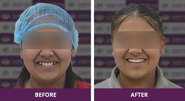 Young girl achieving a perfect smile with orthodontic expertise at Complete Dental Care, New Delhi.