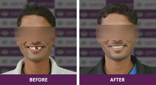 Young man regaining his confident smile with a dental implant restoration at Complete Dental Care, New Delhi.