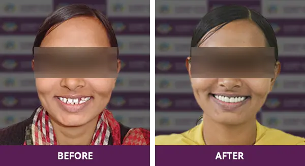 Bride-to-be with a beautiful, professionally corrected smile using crowns at Complete Dental Care, New Delhi.