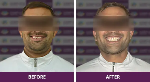 Man’s broken teeth expertly restored with a single crown treatment at Complete Dental Care in New Delhi.