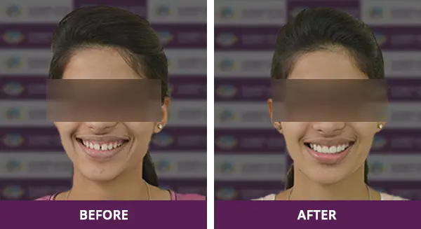 Young girl’s teeth gaping issue professionally corrected with veneers, regaining her confident smile at Complete Dental Care, New Delhi.