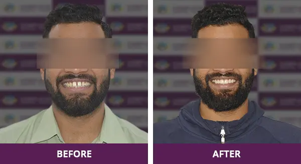 Young man’s smile perfected with expert veneer application at Complete Dental Care in New Delhi.